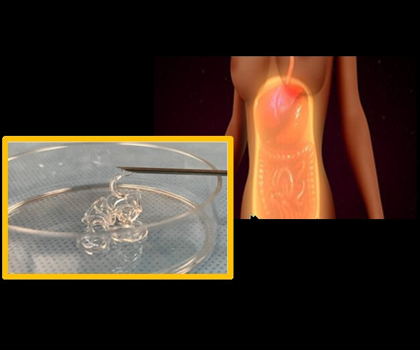 Preventing Postsurgical Adhesions using Hydrogel Barriers
