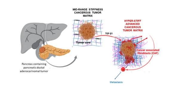 Advanced Pancreatic Cancer Model for Developing Personalized Therapies